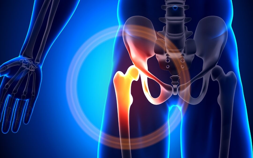 Imagem do post: Bursite Trocantérica: Tudo Que Você Precisa Saber Para se Livrar da Dor no Quadril