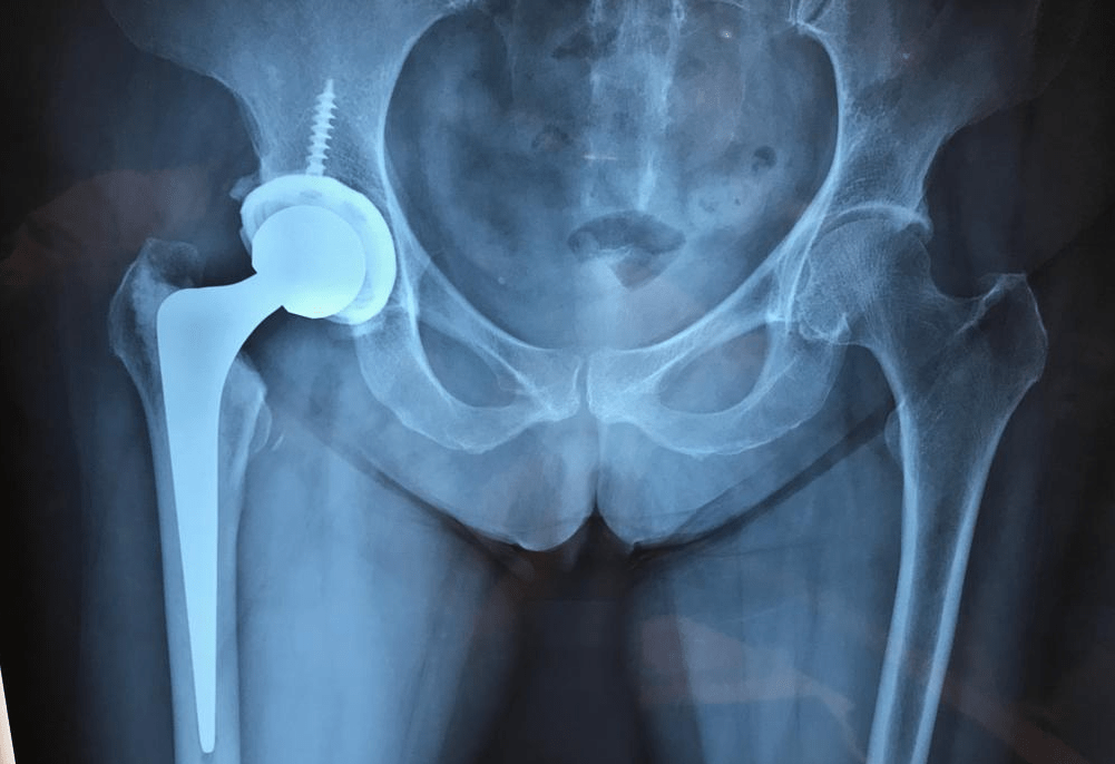 Foto de Prótese de Quadril