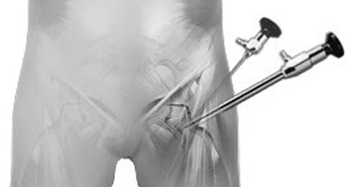 Artroscopia do Quadril
Cirurgia minimamente invasiva para tratar impacto femoroacetabular, les&otilde;es do l&aacute;brum e outras condi&ccedil;&otilde;es. Recupera&ccedil;&atilde;o mais r&aacute;pida, menos dor p&oacute;s-operat&oacute;ria.