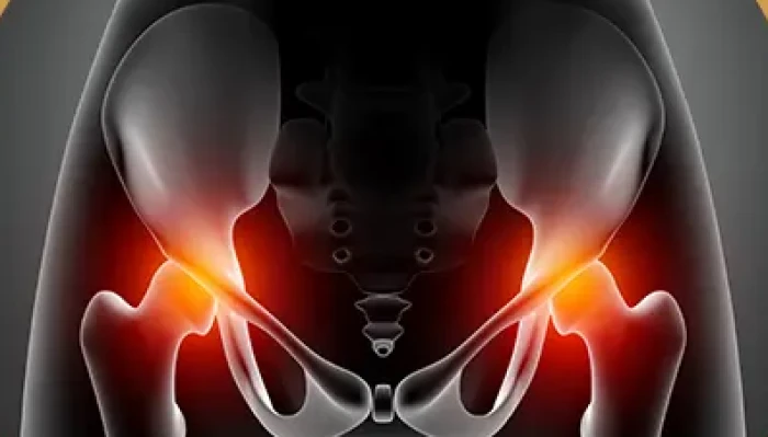 Imagem do serviço Artrose no Quadril