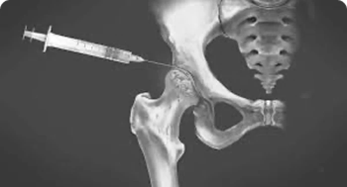 Tratamento Conservador em Medicina Regenerativa
Nem todo problema no quadril precisa de cirurgia. Infiltra&ccedil;&otilde;es, fisioterapia direcionada e medicamentos podem resolver muitos casos.