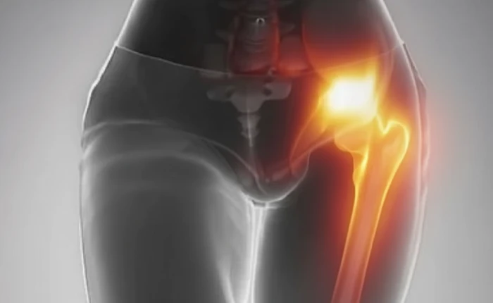 Imagem do serviço Tratamento de Dor Articular e Extra-Articular do Quadril