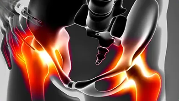 Imagem do serviço Fratura do fêmur proximal