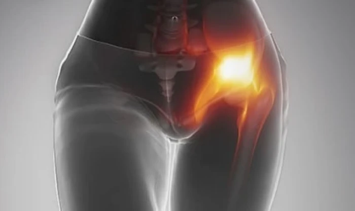 Imagem do serviço Fratura de pelve e acetábulo