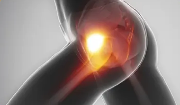 Imagem do serviço Impacto femoroacetabular