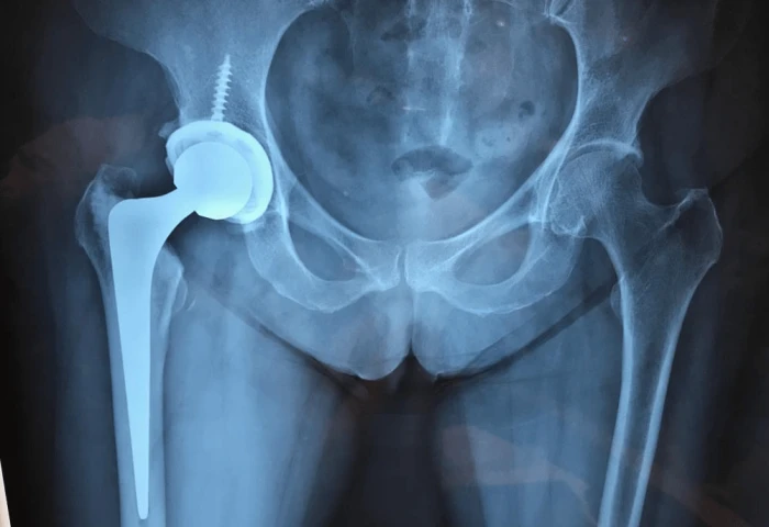 Imagem do serviço Prótese de Quadril