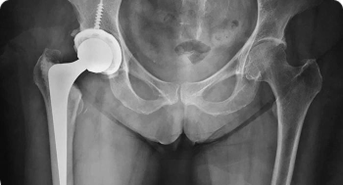 Pr&oacute;tese Total do Quadril
Para casos de artrose avan&ccedil;ada ou necrose da cabe&ccedil;a femoral. Utilizo as pr&oacute;teses mais modernas, com t&eacute;cnicas que preservam m&uacute;sculos.